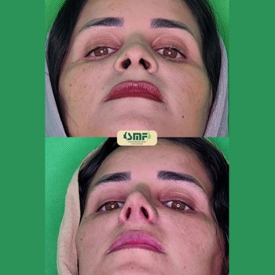 rhinoplasty67
