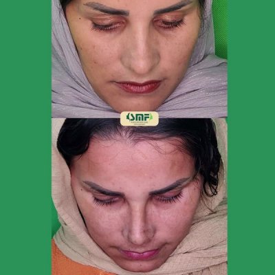 rhinoplasty68