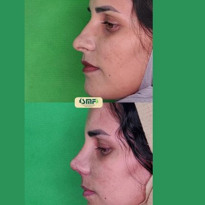 rhinoplasty69