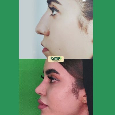 rhinoplasty70