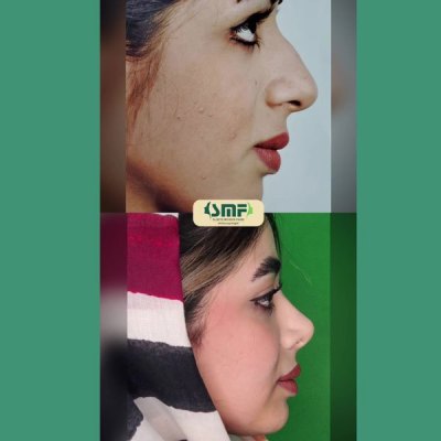 rhinoplasty74