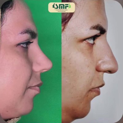 rhinoplasty77