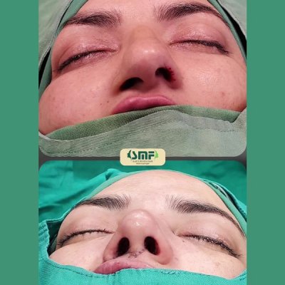 rhinoplasty78