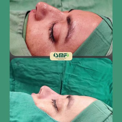 rhinoplasty79