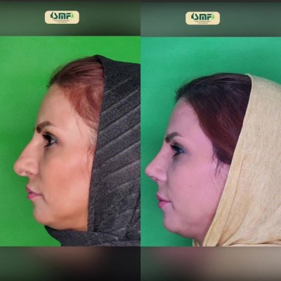 rhinoplasty87