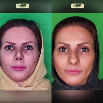rhinoplasty88