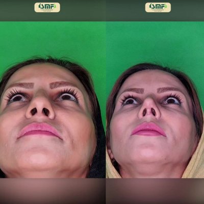 rhinoplasty89
