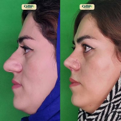 rhinoplasty90