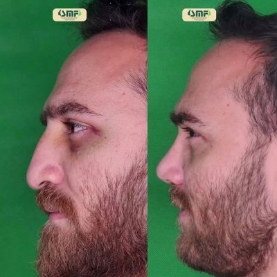 rhinoplasty91