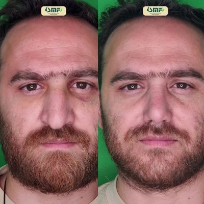 rhinoplasty92