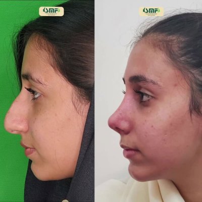 rhinoplasty93