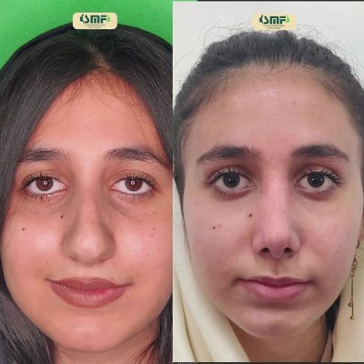 rhinoplasty94
