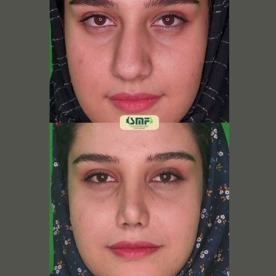 rhinoplasty96