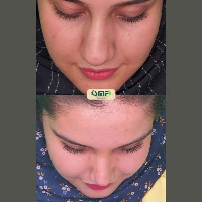 rhinoplasty97