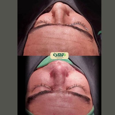 rhinoplasty98