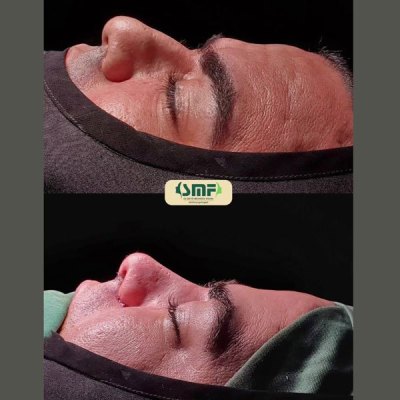 rhinoplasty99