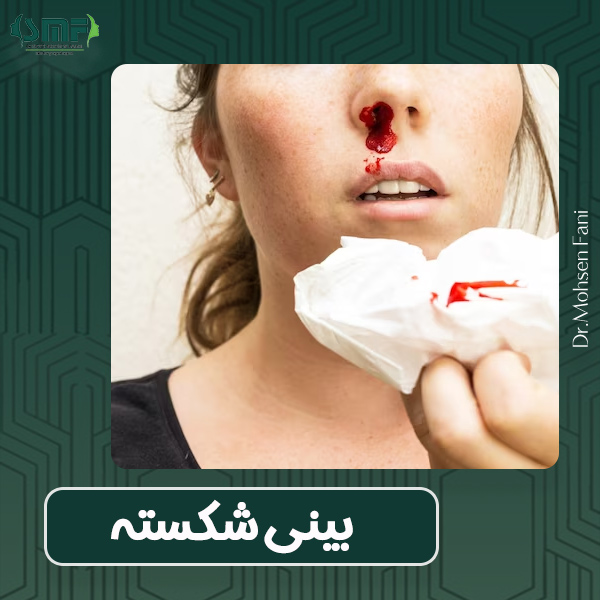 بینی شکسته - دکتر محسن فانی 