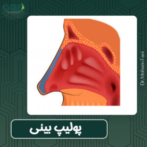 پولیپ بینی و درمان آن در یزد - دکتر محسن فانی