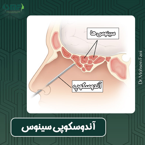 آندوسکوپی سینوس - دکتر محسن فانی
