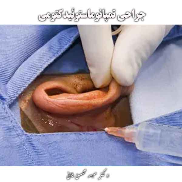جراحی تمپانوماستوئیدکتومی