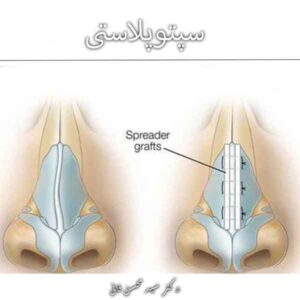 سپتوپلاستی