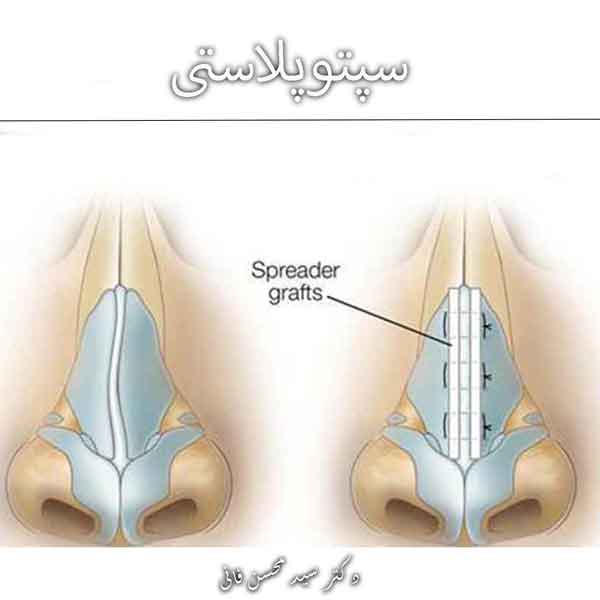 سپتوپلاستی