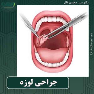 جراحی لوزه