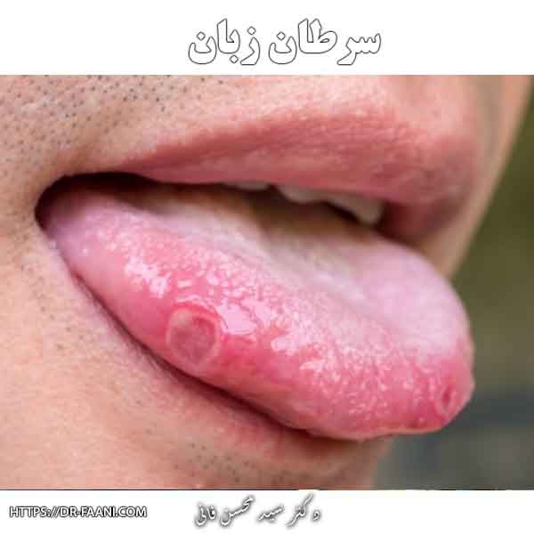 سرطان زبان