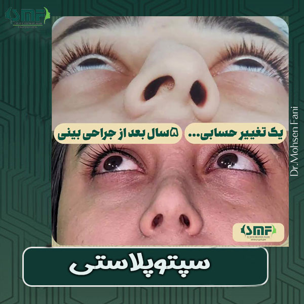 سپتوپلاستی