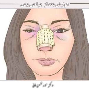 عوارض بعد از جراحی بینی
