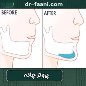 پروتز چانه در یزد دکتر فانی