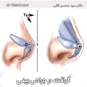 گرافت در جراحی بینی