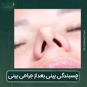 چسبندگی بینی بعد از جراحی بینی