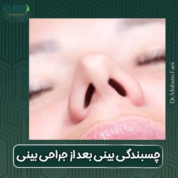 چسبندگی بینی بعد از جراحی بینی