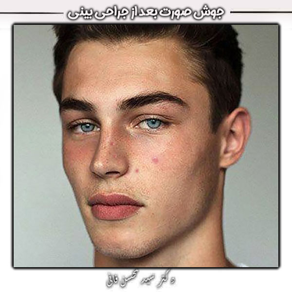 acne after rhinoplasty