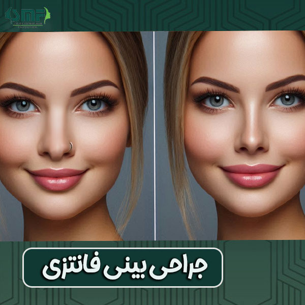 جراحی بینی فانتزی از دکتر سید محسن فانی ، بهترین جراح بینی یزد