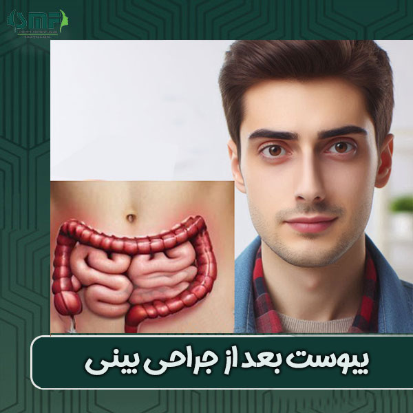یبوست بعد از جراحی بینی دکتر فانی در یزد