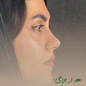 نمونه جراحی بینی طبیعی - دکتر محسن فانی - dr-faani.com