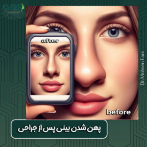 پهن شدن بینی بعد از جراحی دکتر سید محسن فانی