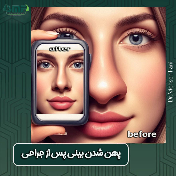 پهن شدن بینی بعد از جراحی دکتر سید محسن فانی
