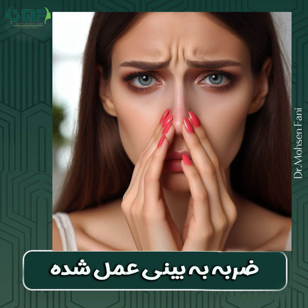 ضربه به بینی عمل شده ، توسط دکتر سید محسن فانی ،بهترین جراح بینی یزد