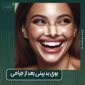 خندیدن بعد از جراحی بینی از دکتر سید محسن فانی ، بهترین جراح بینی در یزد