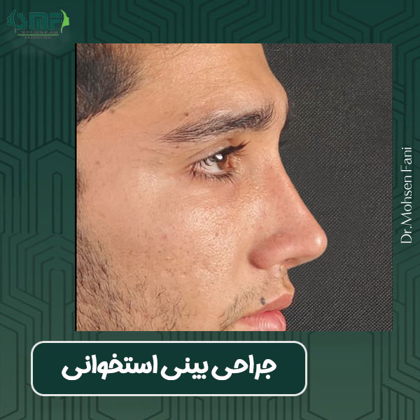 عکس عمل بینی استخوانی - دکتر محسن فانی -dr-faani.com