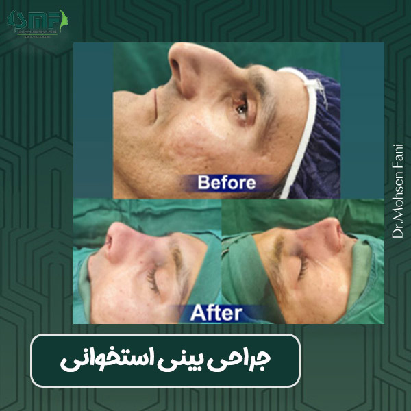 عکس جراحی بینی استخوانی - دکتر محسن فانی -dr-faani.com