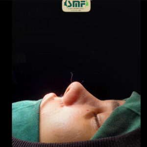 عکس بلافاصله بعد از عمل بینی در یزد - دکتر سید محسن فانی - dr-faani.com