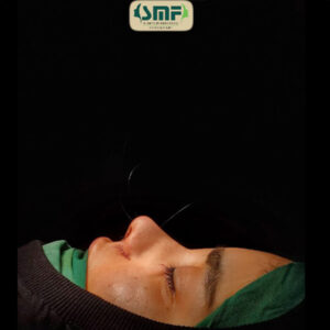 عکس بلافاصله بعد از جراحی بینی در یزد - دکتر سید محسن فانی - dr-faani.com